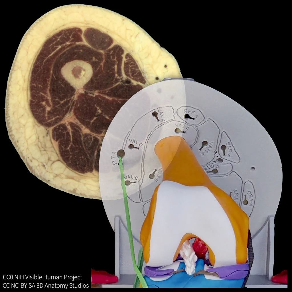 Photo of the knee kit with the superior cross-section plate viewed from the inferior and the knee attached, superimposed with partial opacity on the corresponding mid thigh cryosection from the Visible Human Project.